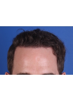 After Hair Transplant&nbsp;Front